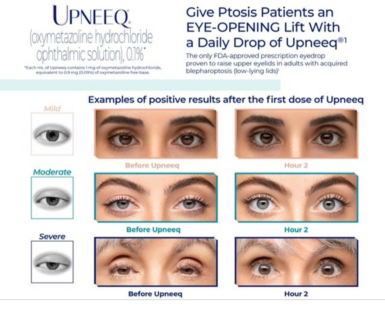 Buy Upneeq Eye Drops for Ptosis Patients Eyes on Brickell