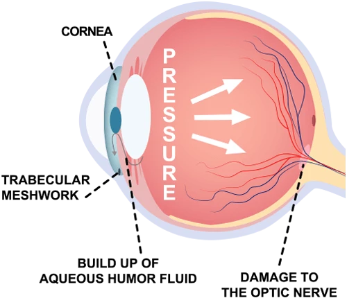 Book an Appointment For Glaucoma Eye Test - Eyes On Brickell Eyes on Brickell: Glaucoma Eye