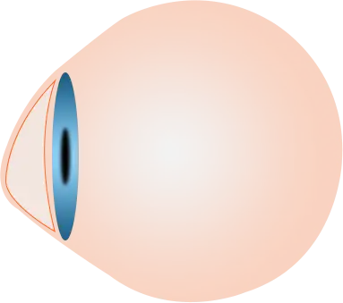 How Keratoconus Eye Looks Like? - Eyes On Brickell Eyes on Brickell: Keratoconus Eye