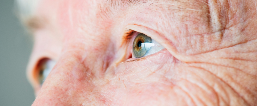 Age related macular degeneration
